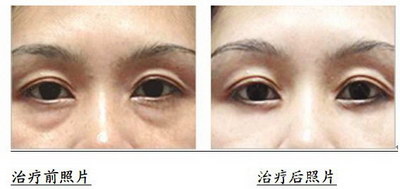双眼皮第二次修复多久可以恢复(修复的需要)