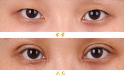 眼睛多次做修复双眼皮(如何进行多次修复双眼皮？)