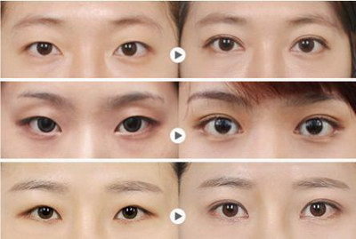 韩式无痕双眼皮的重脸什么意思_韩式无痕双眼皮的原理过程