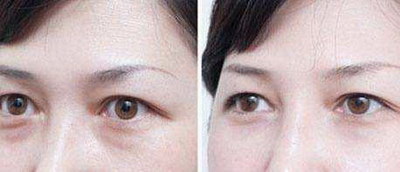 双眼皮手术不满意的几种类型简述