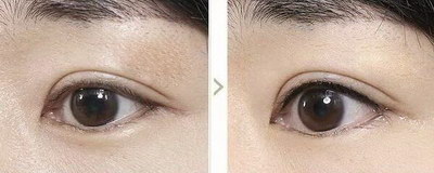 双眼皮修复术把你打造美丽的眼睛