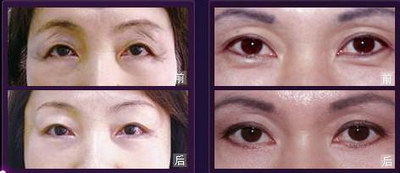 造成双眼皮失败原因有哪几种？