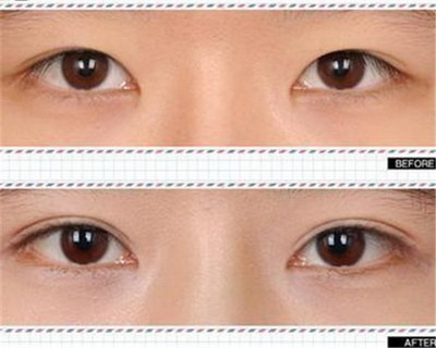 双眼皮手术治疗成功条件