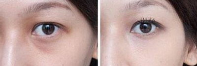 双眼皮术后恢复过程图片_双眼皮术后恢复的五个阶段一定要知道
