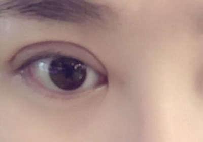 微创双眼皮术后护理要点_什么是韩式微创双眼皮