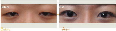 修复眼袋的可能性_二次修复眼袋能够带来更加明显的改善效果
