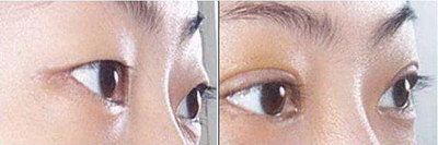 外眼角手术前后(外眼角手术前后对比)