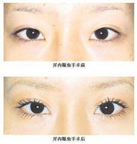 溶脂祛眼袋多久可以化妆「射频溶脂祛眼袋多久可以做美容」