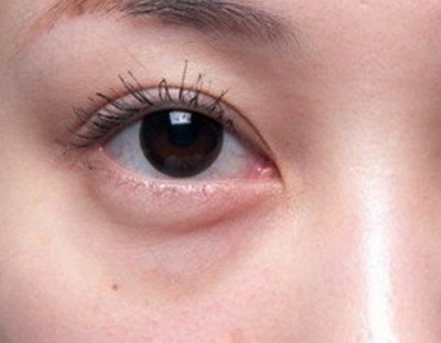 影响双眼皮手术结果的因素有哪些