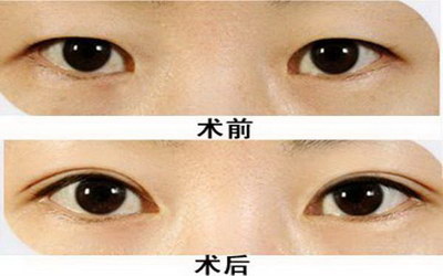 双眼皮疤痕痒是什么原因(预防双眼皮疤痕用什么药)