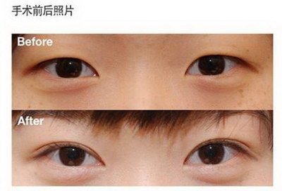 韩式三点双眼皮效果应该是如何的？