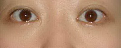 单眼皮和双眼皮的区别在哪里_双眼皮可以做成单眼皮的案例