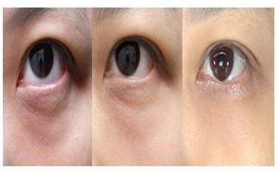 快速消除黑眼圈的7个超有效方法