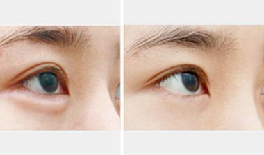 单眼皮双眼皮遗传图谱(为什么双眼皮是显性遗传而单眼皮的人很多)