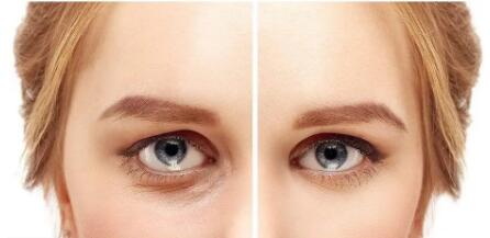 全切双眼皮需要多久可以恢复_全切双眼皮需要多久可以自然