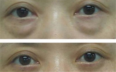 双眼皮术后恢复要多久没有「韩式双眼皮术后多久恢复」