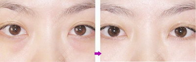 40岁做双眼皮恢复过程(双眼皮的恢复过程)