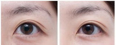 双眼皮多久能用眼药水(埋线双眼皮术后多久能用眼药水)