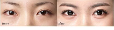 如何从单眼皮变成双眼皮:一步一步实现完美眼妆_眼皮贴久了会成双眼皮吗