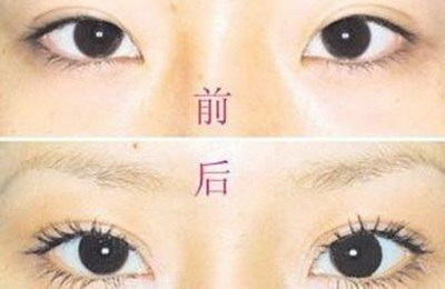 切双眼皮手术适合的佳年龄_北京切双眼皮哪位医生最好