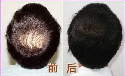 种植头发要多久恢复好(种植头发恢复时间因人而异)