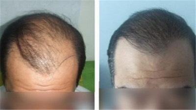 植发后头皮神经多长时间恢复「植发后头皮麻木感多长时间能消失」