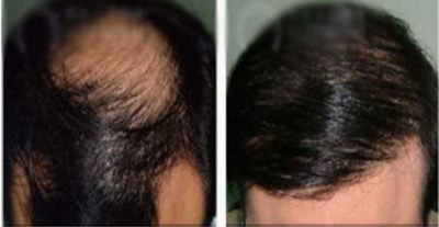 毛囊萎缩导致的脱发如何治疗方法(毛囊萎缩如何治疗)