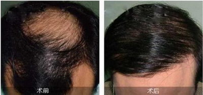 掉的头发多久能长出来_植发后脱落的头发多久长出来