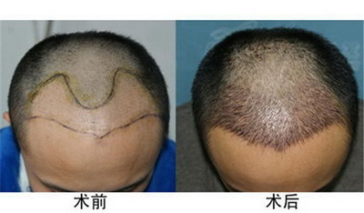 烫发对头发的伤害多久完全修复(烫发对头发的伤害是永久的吗)