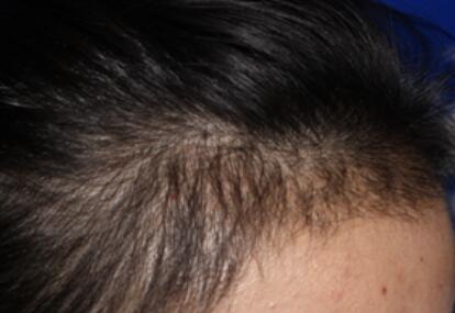 植发美人尖需要多少单位(m型发际线植发需要多少单位)