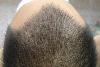 种植的头发能管多少年(种植头发能保多少年)