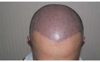 植发后多久可以做第二次手术_植发多久可以种第二次