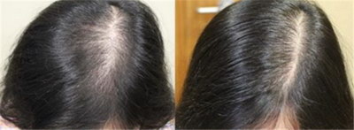 掉头发传统治疗是什么？