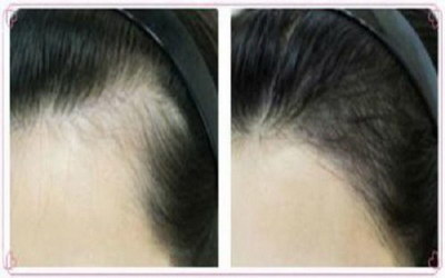 头发种植后的正确护理方法