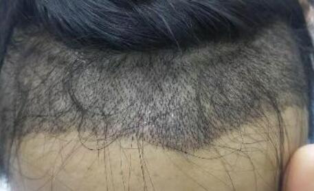 毛发移植的成活率有哪些影响因素？