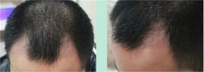 植发后取发区恢复图片(植发后恢复过程图片)