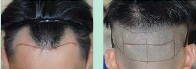 毛发移植的过程和针对人群