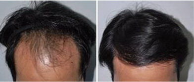 睫毛种植对取毛部位有影响吗？