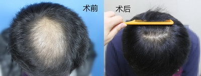 上海毛发种植价格是多少(上海毛发种植一般价格多少钱)