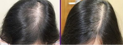 种植头发手术需要多长时间_种植头发大概需要手术多长时间