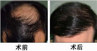 植发可以改变头发生长方向吗