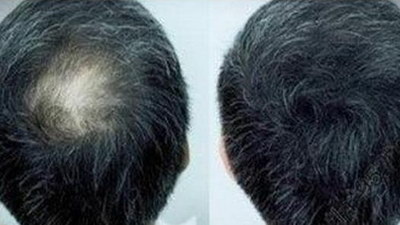 植发一个月效果男士(植发后一个月效果图)