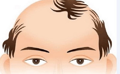 男性掉头发是什么原因引起的掉(男性掉头发是什么原因引起的)