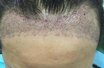 发际线高做植发有危害么？