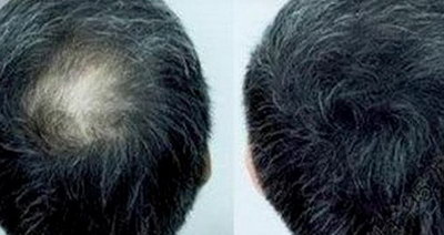 植发对头皮有伤害吗(植发对头皮有害吗)