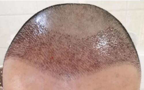 种植头发对头皮有伤害吗