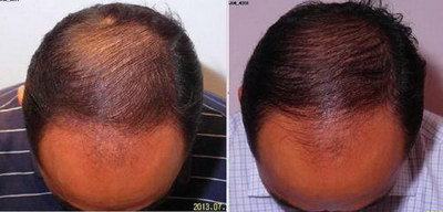 头发种植需要多久生长出一厘米_头发种植需要多久