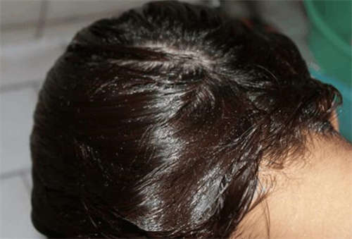 发际线植发怎么样效果如何-本人发际线太低，额头太窄?