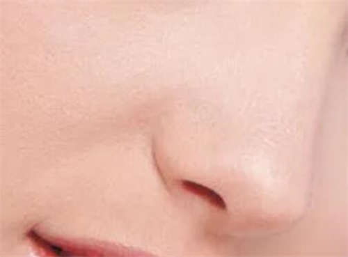 瞄一眼自贡市贡井区黄金3D综合塑鼻鼻翼缩小术top榜6强整形医生