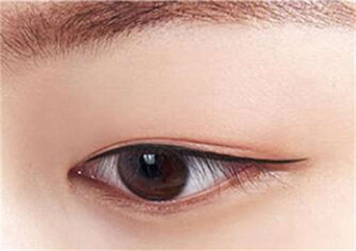 2023年衢州市埋线双眼皮手术矫正三角眼哪个医院是正规的